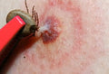 Quick Tick Remover Tool Used for Tick Removal (Humans, Dogs, Cats, Animals)